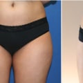 How Cosmetic Liposuction In Chevy Chase, Maryland Can Support Personal Development And Improve Mental Health?