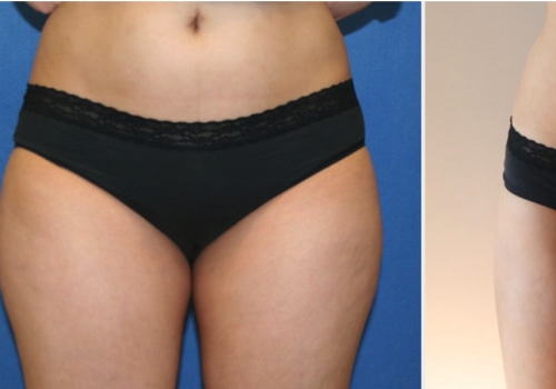 How Cosmetic Liposuction In Chevy Chase, Maryland Can Support Personal Development And Improve Mental Health?